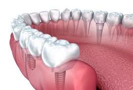 dental implants