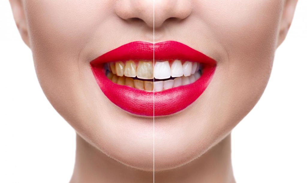 Teeth Whitening Ottawa