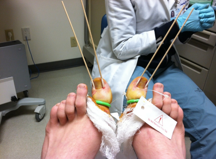 surgery on ingrown toenail