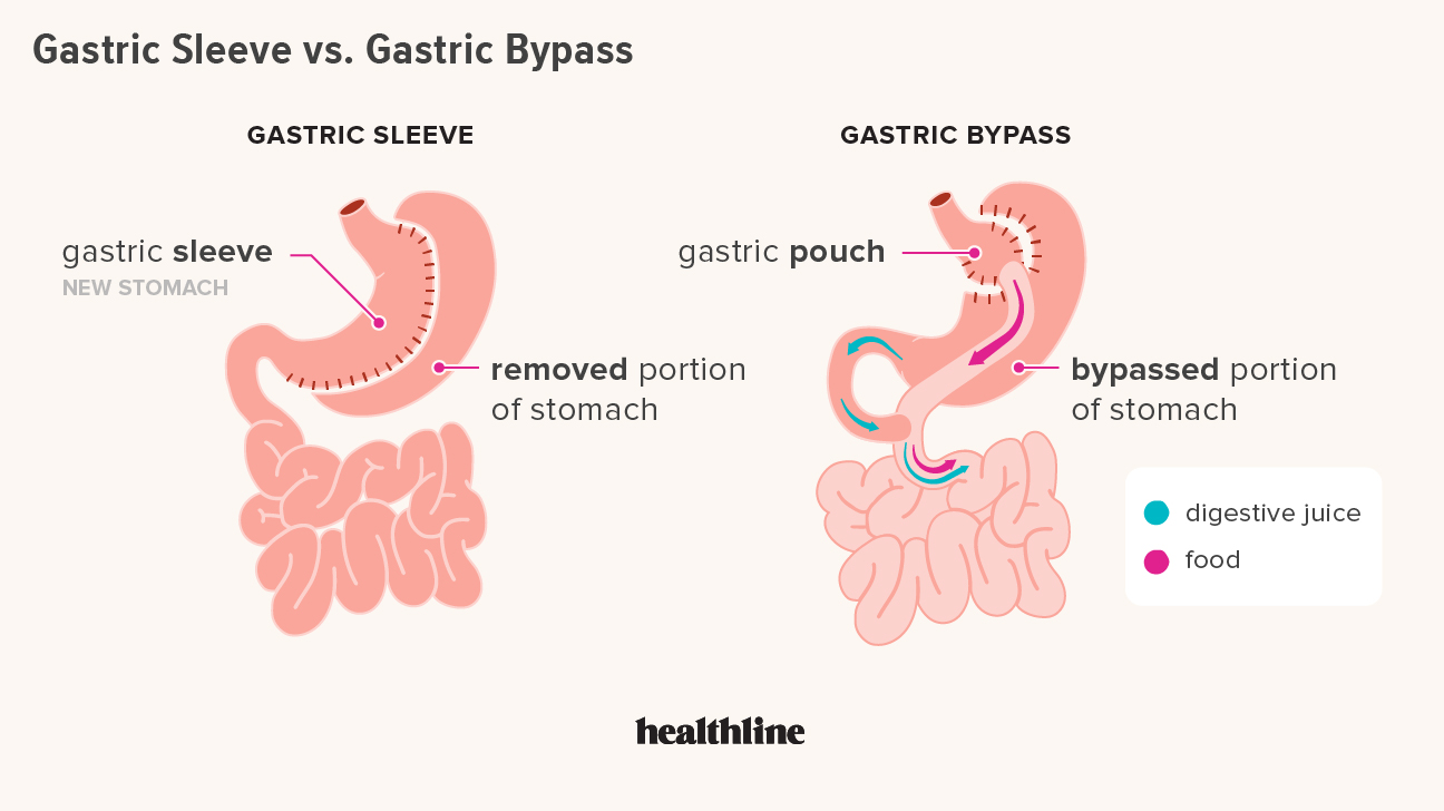 gastric bypass sleeve