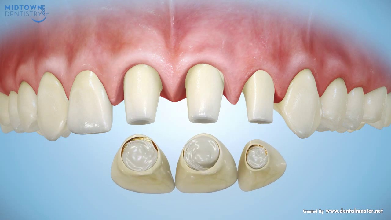 porcelain dental veneers