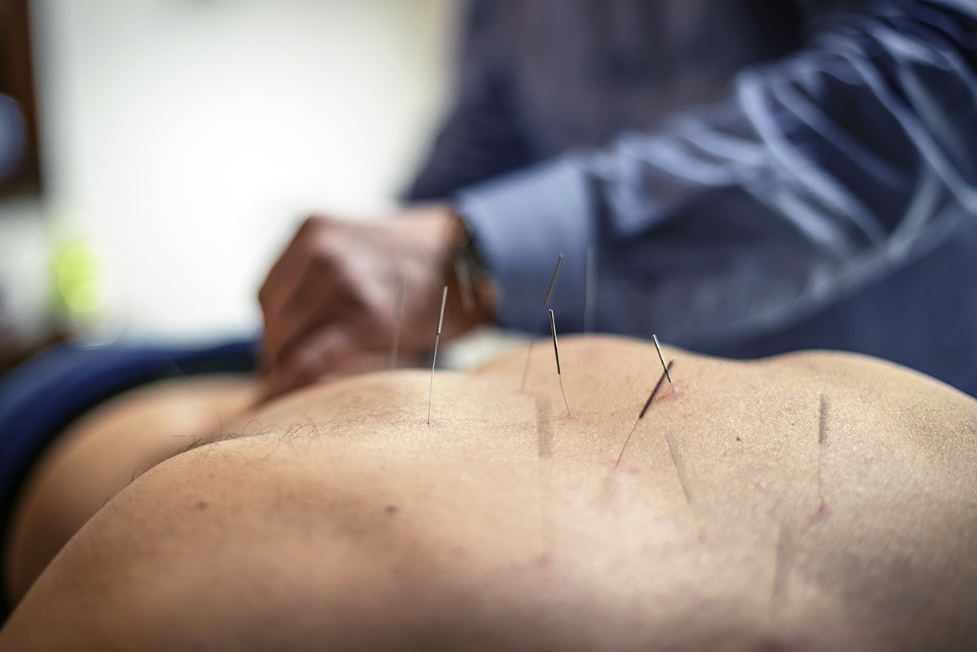 Acupuncture massage