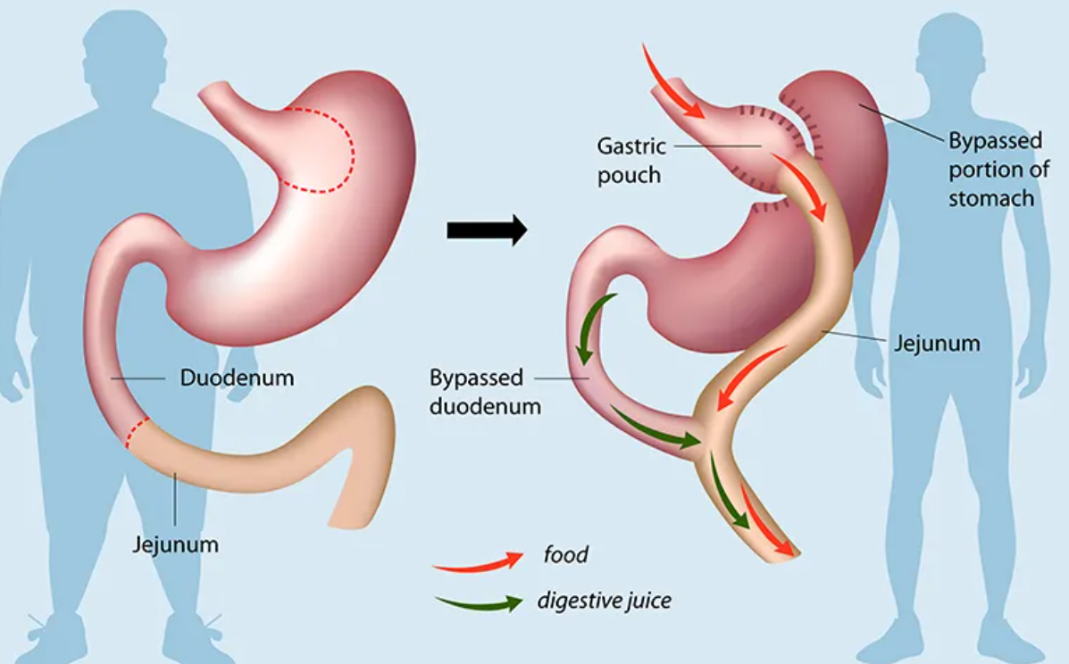 Bypass stomach