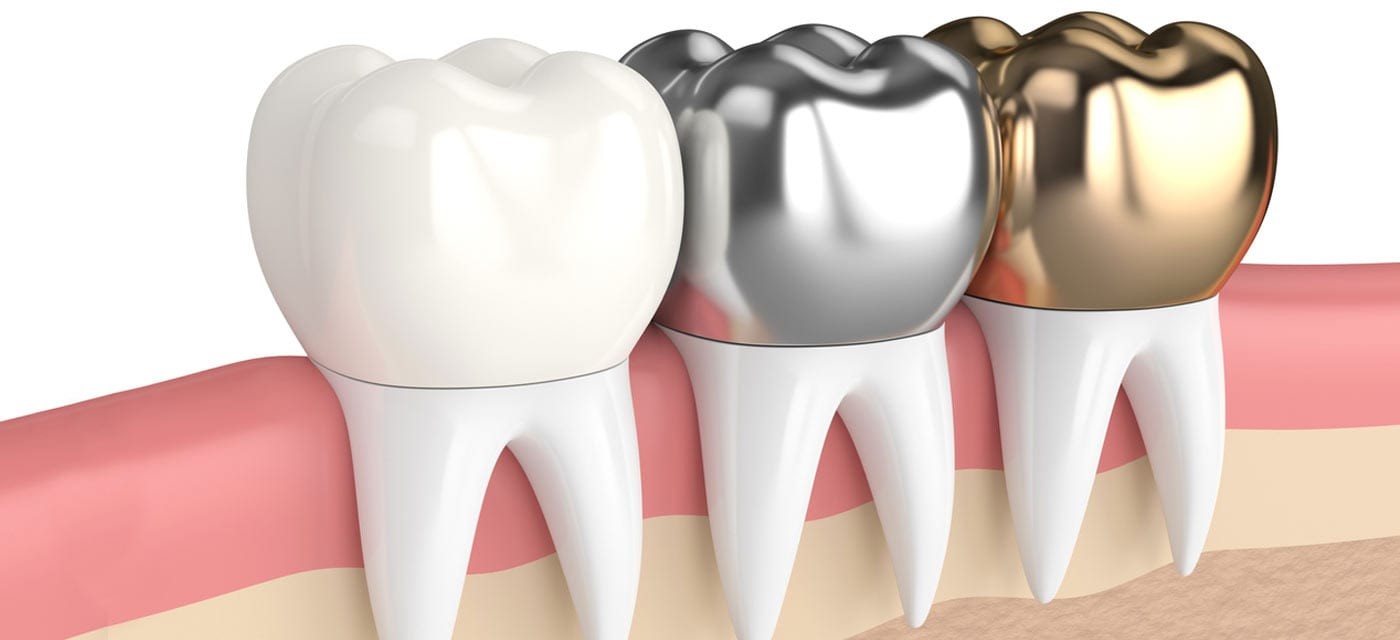 Dental crowns