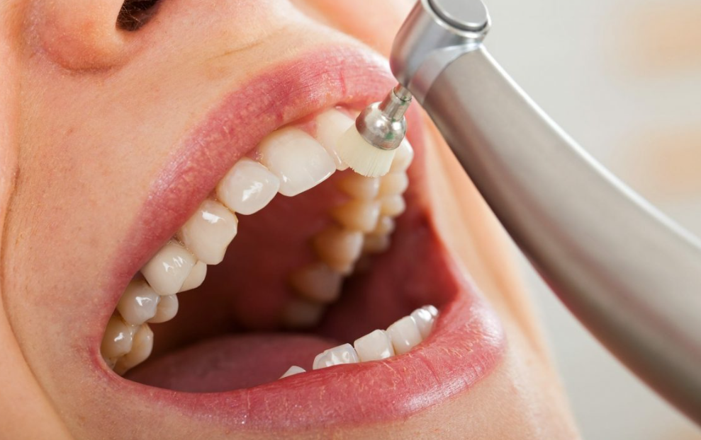 Dental cleaning