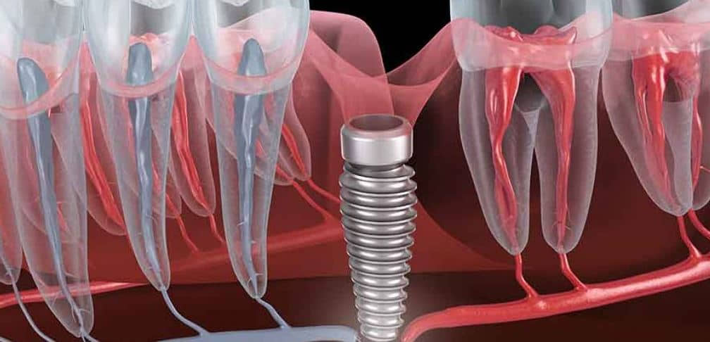 Dental implant infection symptoms