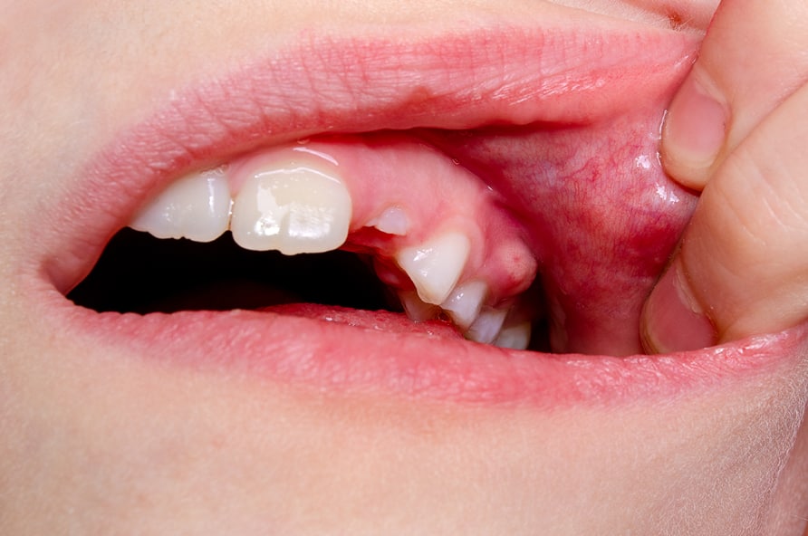 dental implant infection symptoms