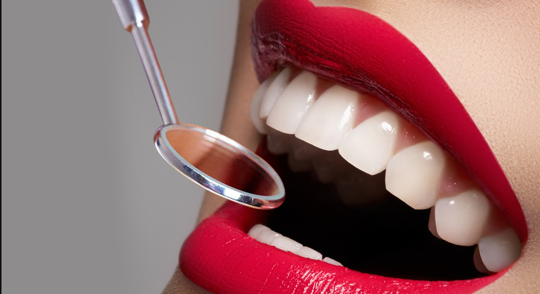 dental veneers