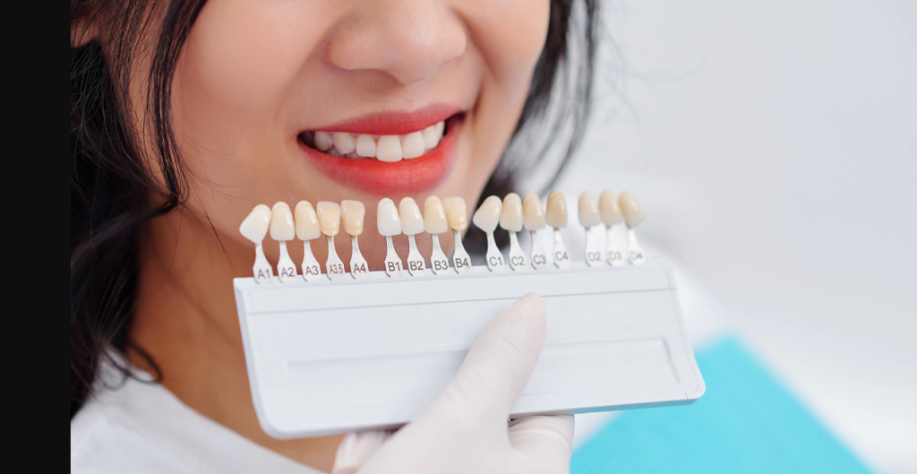 dental veneers