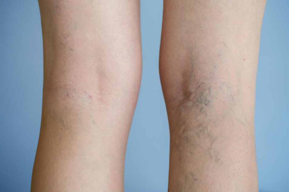 aching varicose veins
